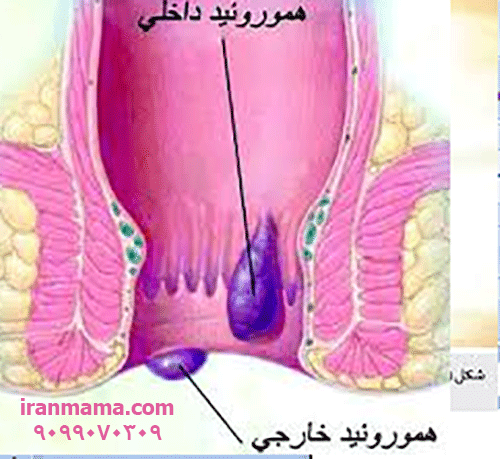 درمان بواسیر در طب سنتی